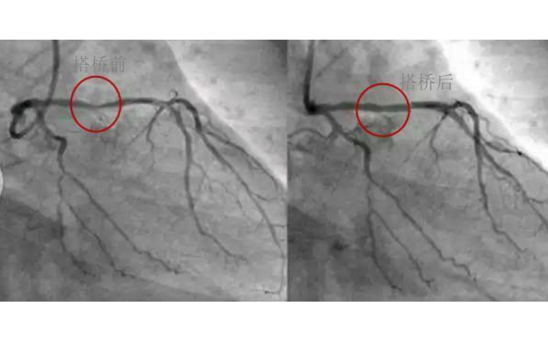 深圳市模具廠對(duì)心臟支架的關(guān)注，國(guó)產(chǎn)化的道路有多長(zhǎng)？
